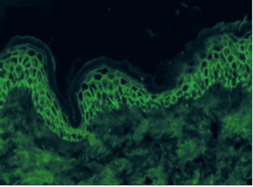 My skin peels off in blisters